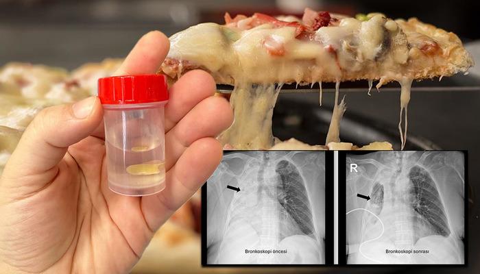 Yediği yemek az kalsın hayatından ediyordu: Sağ akciğeri tamamen kapandı! Soluk borusunu tıkadığı 5 ay sonra ortaya çıktı…