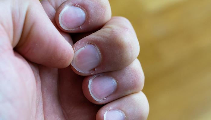 Uzman isimden kritik uyarı: Tırnaklarda başlayan tehlike! ‘Fark etmeden diş köklerini eritiyor’